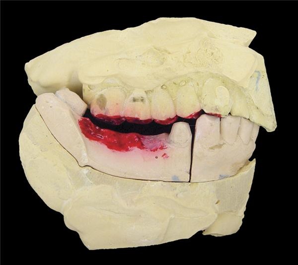 - Elvis Presley’s Teeth Mold from his Dentist