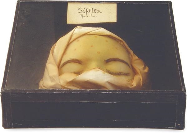- 1890's Syphilis Museum Display