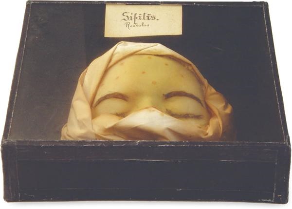 1890's Syphilis Museum Display