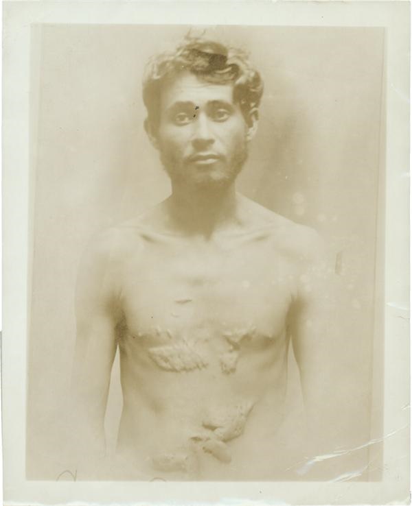 Torture Victim Circa 1915